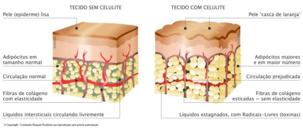 imagem-celulite-1024x436