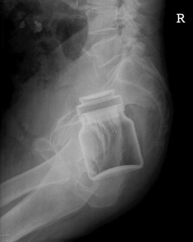 rectal-foreign-body-instant-coffee-jar