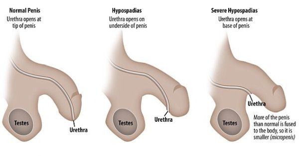1415704645832_wps_2_Hypospadias_penis_graphic