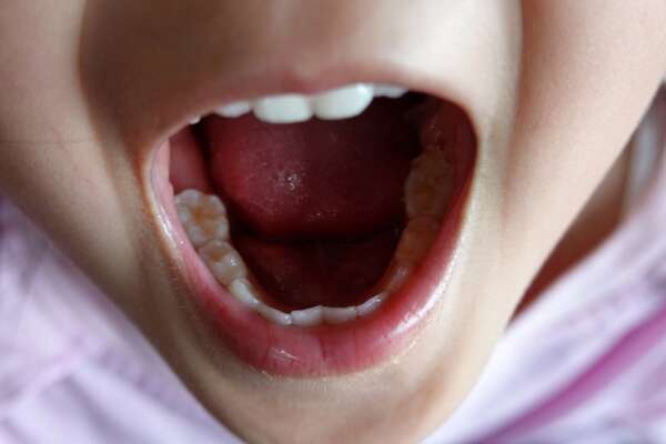 Dentes infantis