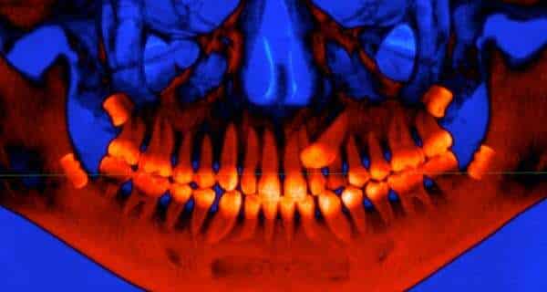 Raio X de dentes