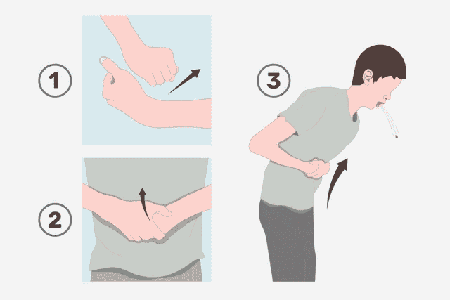 manobra de heimlich em si